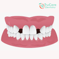 Dental bonding is a relatively simple procedure that requires a dentist to cover a tooth with a dental resin. Fix Gap In Front Teeth Trucare Dentistry Roswell