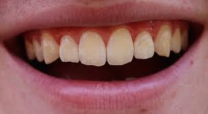 Cleaning teeth thoroughly when you have braces is usually tricky, and in some cases, plaque or food debris may accumulate around the braces and lead. White Spots On Teeth What Can You Do Smile Stories