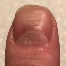 habit tic nail deformity