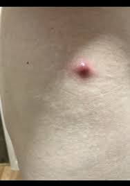 what is this cyst ingrown hair boil