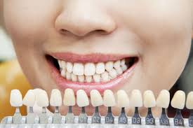 Selecting The Right Shade Of Dental Veneers Is Essential