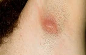 It is common after shaving your underarms and should go away on its own. Armpit Blisters