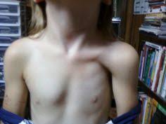 Poland syndrome is a disorder in which affected individuals are born with missing or underdeveloped muscles on one side of the body, resulting in abnormalities that can affect the chest, shoulder, arm, and hand. 900 Nursing Medical Ideas Medical Nursing Study Nursing Notes