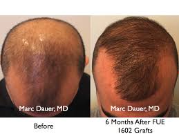 Even up to 18 months), the vast vast majority of patients experience some nice growth by 8 months. Fue Hair Transplant At 6 Months Marc Dauer Md Hair Transplant Doctor Los Angeles