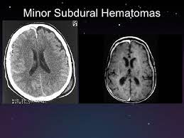 Do not cross suture lines because of the tight adherence of the dura to the calvarium and. Subdural And Epidural Hematomas