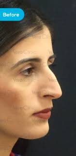 how to make your nose smaller naturally