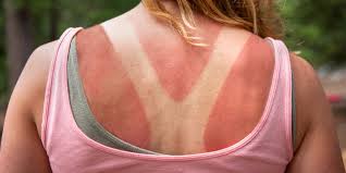 Black skin absorbs more radiation than any other skin tone. The Top 10 Sunburn Soothing Products According To Dermatologists