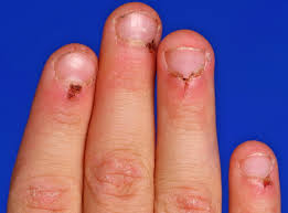 capillary nail fold abnormalities 3
