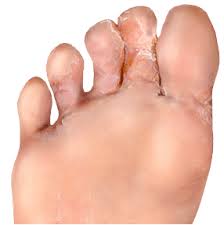 athlete s foot foot fungal infection