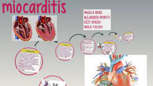 Discover myocarditis causes, symptoms, diagnosis and treatment about myocarditis. Miocarditis By Ozzy Oviedo