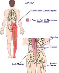 Diverticulitis occurs when diverticula (small pouches) in the intestinal wall become. Back Pain Home Facebook