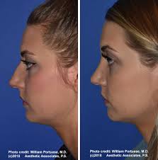 Maybe you would like to learn more about one of these? Rhinoplasty Seattle Wa Nose Surgery Nose Job Bellevue