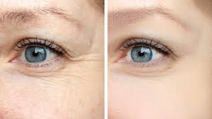 under eye wrinkles prevent and treat
