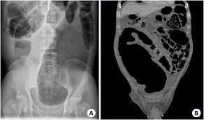 colonic pseudo obstruction in a patient