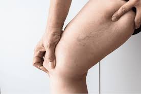 the dangers of neglecting spider veins