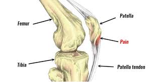 patellar tendonitis jumper s knee