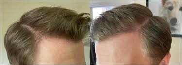 hair transplant after 6 months the
