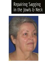 How to slim your facelifting saggy jowlsif you are interested in lifting saggy jowls and how to slim your face, my video on lifting sagging jowls may be of i. How To Reduce Sagging Jowls And Neck Unugtp