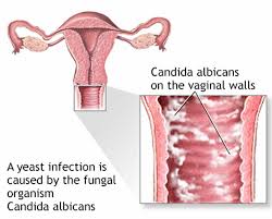 inal yeast infection causes