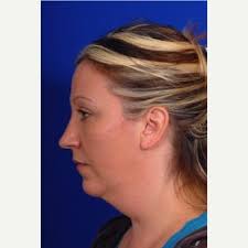 Check spelling or type a new query. How Chin Liposuction Gets Rid Of A Double Chin Realself