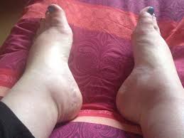 swelling oedema remes photos
