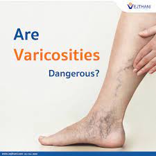 are varicosities dangerous vejthani