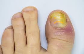get rid of that toenail fungus before