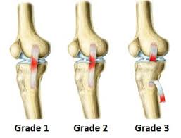 knee sprain causes symptoms