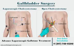 need gallbladder surgery
