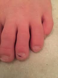 dark spot under nail babycenter