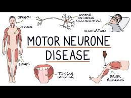 understanding motor neurone disease