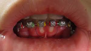 Complex canker sores are uncommon and tend to occur when someone has had canker sores previously. Mouth Sores Pictures Causes Types Symptoms And Treatments