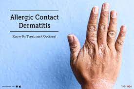 allergic contact dermais know its