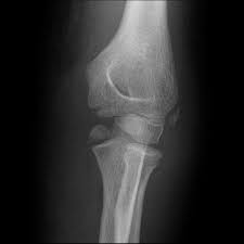 Did you know that the elbow is a synovial hinge joint? Medial Epicondyle Avulsion Radiology Case Radiopaedia Org
