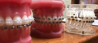 can braces cause your gums to become