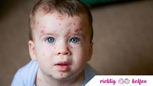 herpes für babys und kleinkinder