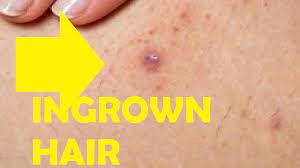 how to get rid of an ingrown hair that