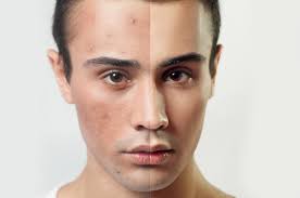 you don t have to live with acne here
