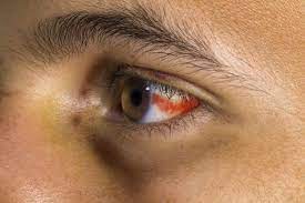 blood in eye causes healing and when
