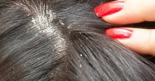 6 reasons for itchy scalp and how to