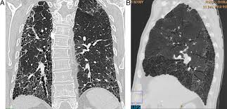 ¿qué es la fibrosis pulmonar? Fibrosis Pulmonar Idiopatica Con Patron Tipico De Neumonia Intersticial Download Scientific Diagram