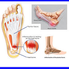 what is plantar fasciitis how to