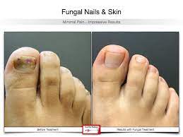 fungal nails foot first podiatry centers
