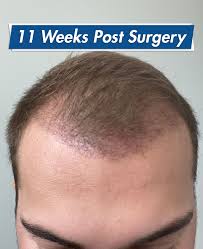 redness after hair transplant how to
