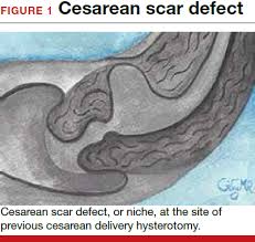 So a few months after surgery you will begin to think about how to remove a scar after cesarean section. Cesarean Scar Defect What Is It And How Should It Be Treated Mdedge Obgyn