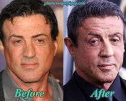 Imagen de Sylvester Stallone before and after plastic surgery