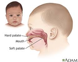 cleft lip and palate information