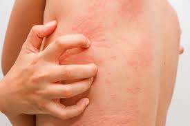what causes hives and how to get rid of
