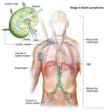 Learn about lymphoma, a cancer that starts in the lymph system. Definition Of Stage Ii Adult Non Hodgkin Lymphoma Nci Dictionary Of Cancer Terms National Cancer Institute