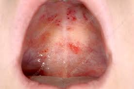 petechial rash in the mouth stock